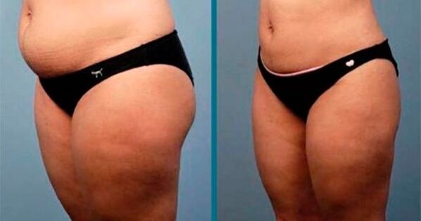 metode za izgubo teže za 10 kilogramov na mesec